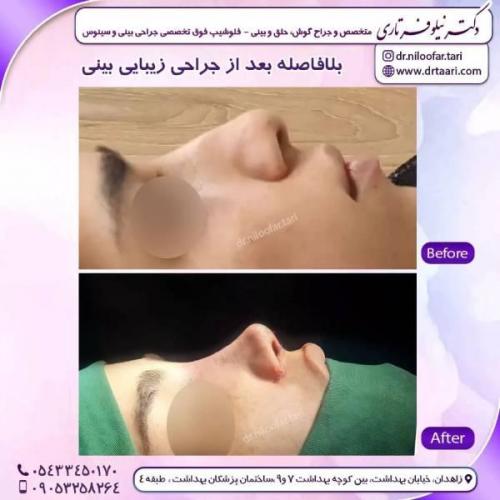 جراحی-بینی-زاهدان-194