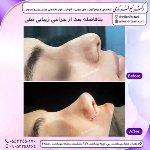 جراحی-بینی-زاهدان-201