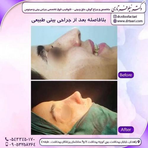 جراحی-بینی-زاهدان-53 