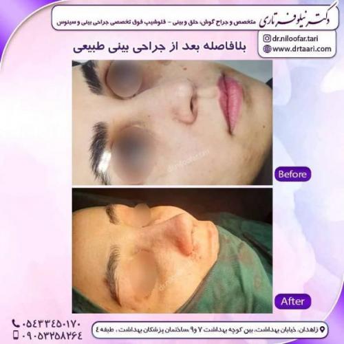 جراحی-بینی-زاهدان-54 
