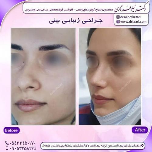 جراحی-بینی-زاهدان-55 