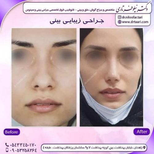 جراحی-بینی-زاهدان-56 (1)