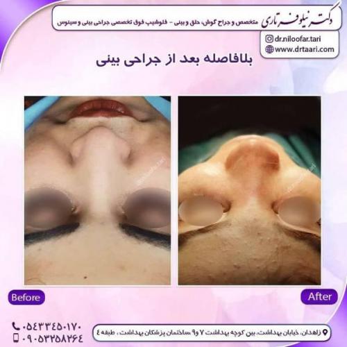 جراحی-بینی-زاهدان-57 (1)