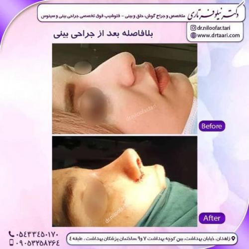 جراحی-بینی-زاهدان-58 (1)