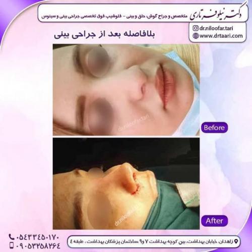 جراحی-بینی-زاهدان-59 (1)