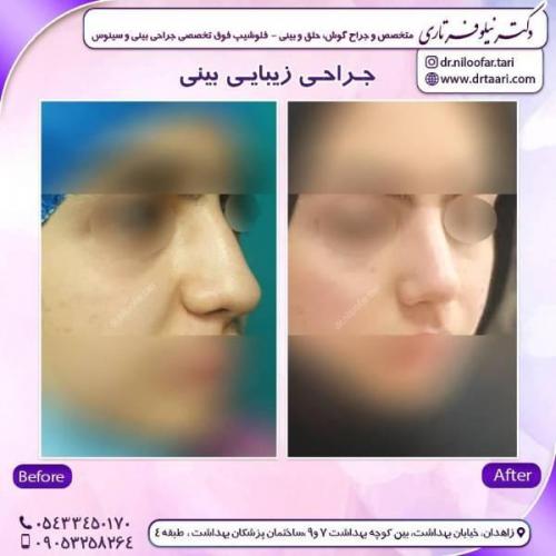 جراحی-بینی-زاهدان-60
