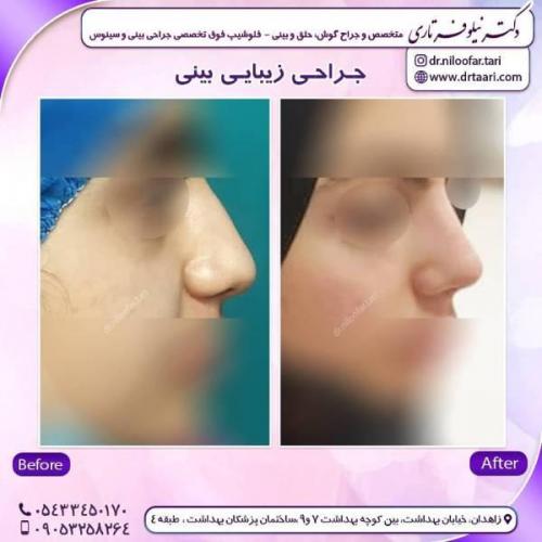 جراحی-بینی-زاهدان-61