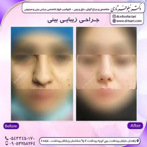 جراحی-بینی-زاهدان-62
