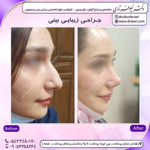 جراحی-بینی-زاهدان-63 