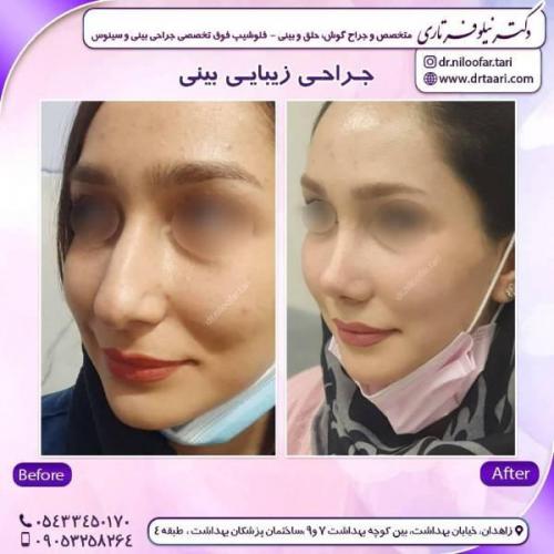 جراحی-بینی-زاهدان-64 