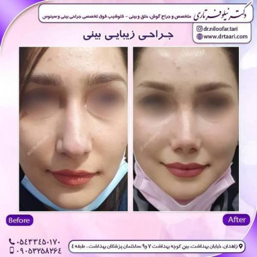 جراحی-بینی-زاهدان-65 