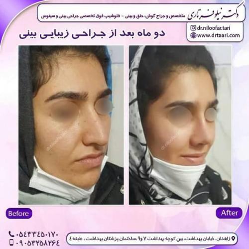 جراحی-بینی-زاهدان-66