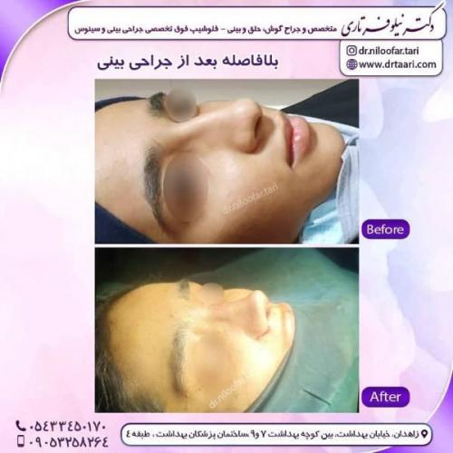 جراحی-بینی-زاهدان-67 