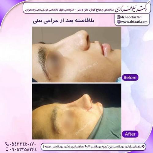جراحی-بینی-زاهدان-68