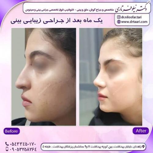 جراحی-بینی-زاهدان-69