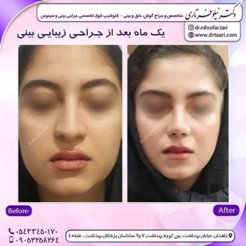 جراحی-بینی-زاهدان-71 