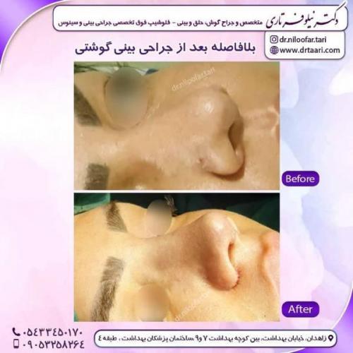 جراحی-بینی-زاهدان-72 