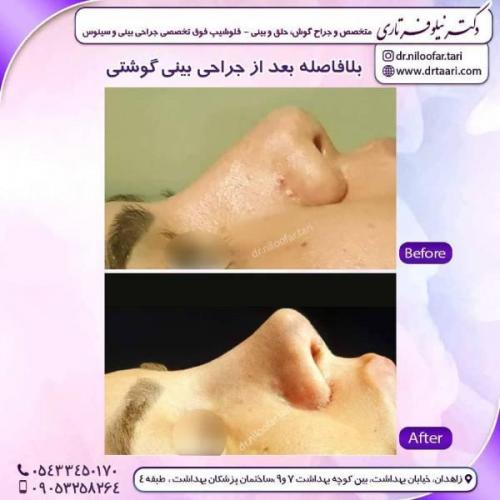 جراحی-بینی-زاهدان-73 