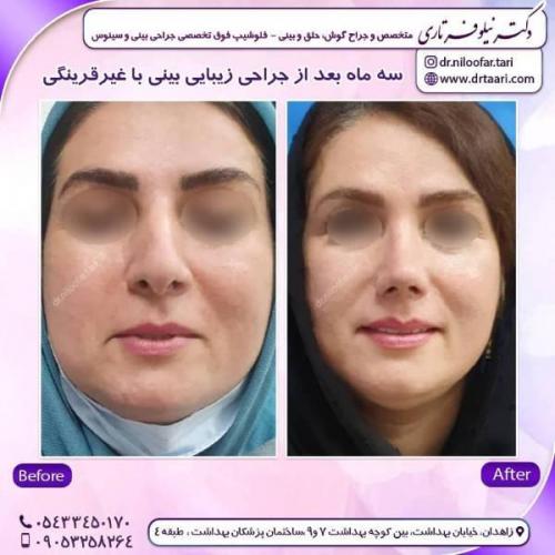 جراحی-بینی-زاهدان-74 
