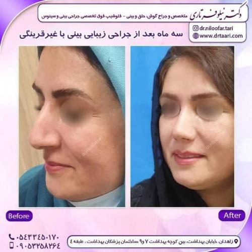 جراحی-بینی-زاهدان-75 