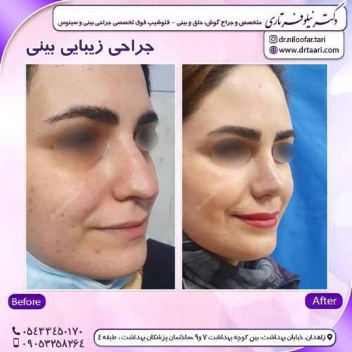 جراحی-بینی-زاهدان-76