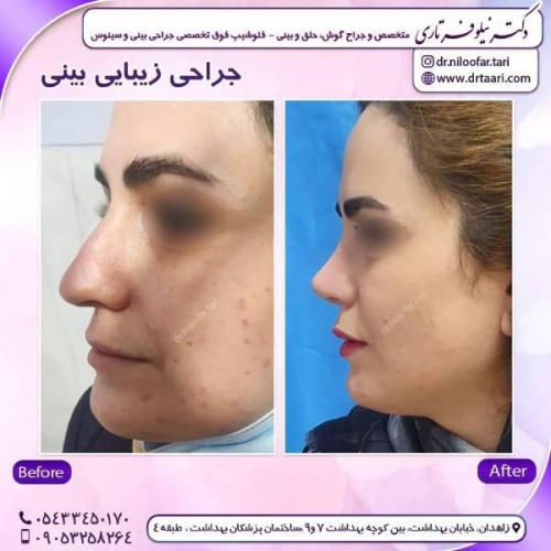 جراحی-بینی-زاهدان-77 