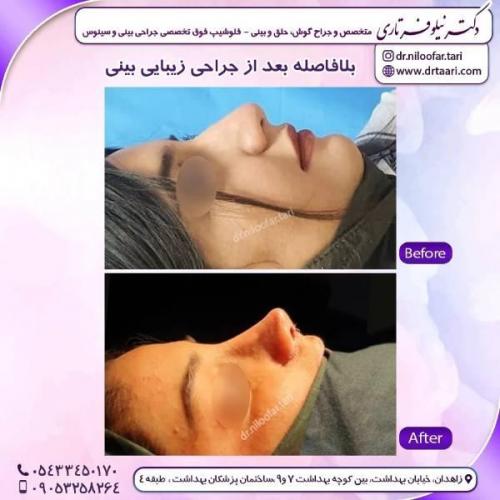 جراحی-بینی-زاهدان-80 