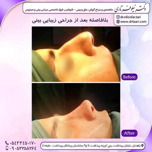 جراحی-بینی-زاهدان-83 