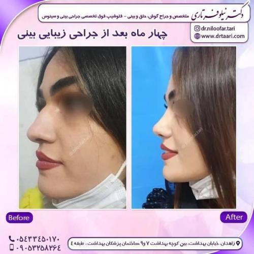 جراحی-بینی-زاهدان-84 