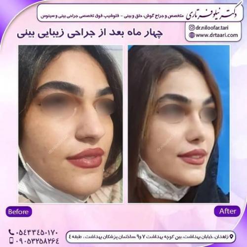 جراحی-بینی-زاهدان-85