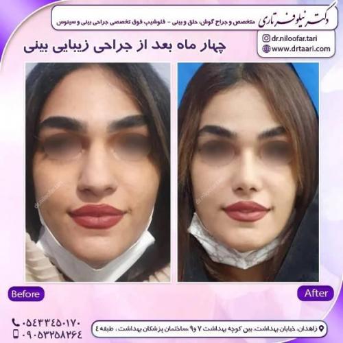 جراحی-بینی-زاهدان-86 