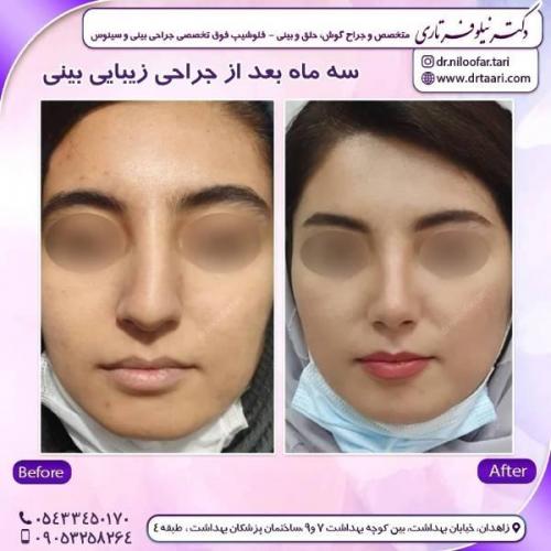 جراحی-بینی-زاهدان-87 