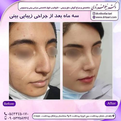 جراحی-بینی-زاهدان-89 