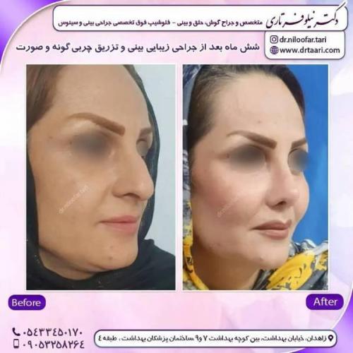 جراحی-بینی-زاهدان-90 