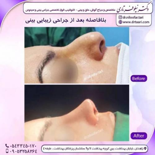 جراحی-بینی-زاهدان-91 