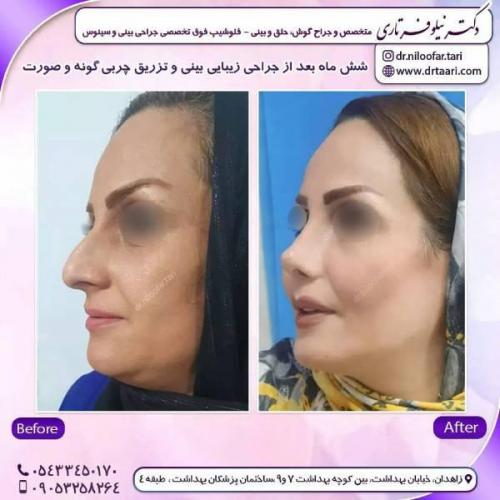 جراحی-بینی-زاهدان-92 