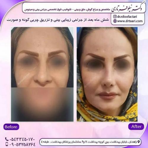 جراحی-بینی-زاهدان-93 