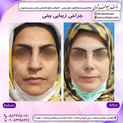 جراحی-بینی-زاهدان-94 