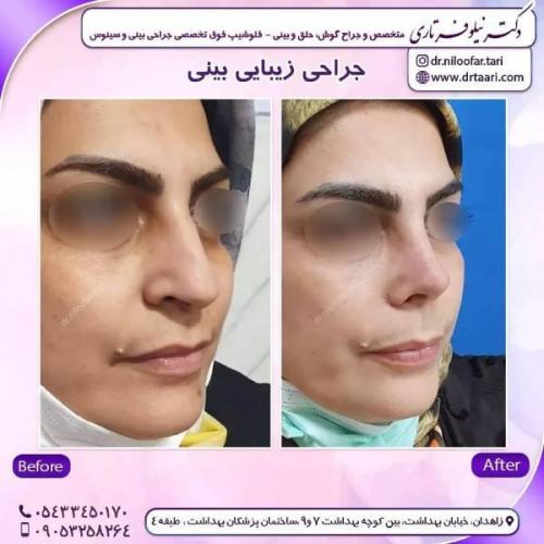 جراحی-بینی-زاهدان-95