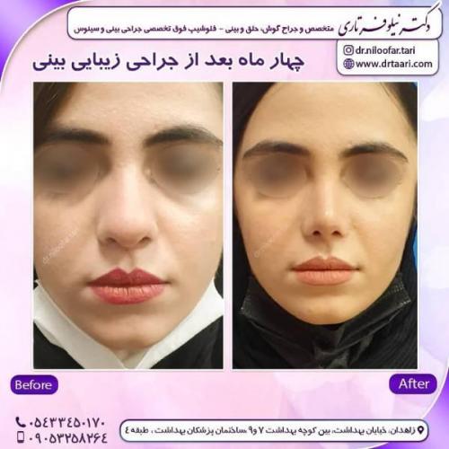 جراحی-بینی-زاهدان-96