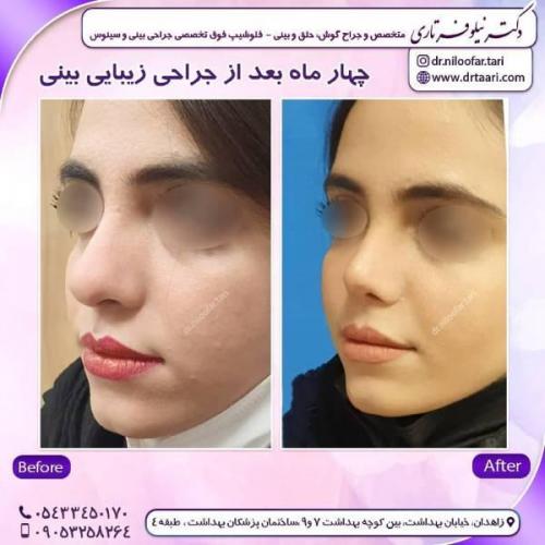 جراحی-بینی-زاهدان-97
