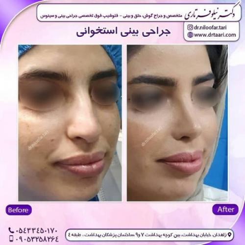 جراحی-بینی-زاهدان-98 