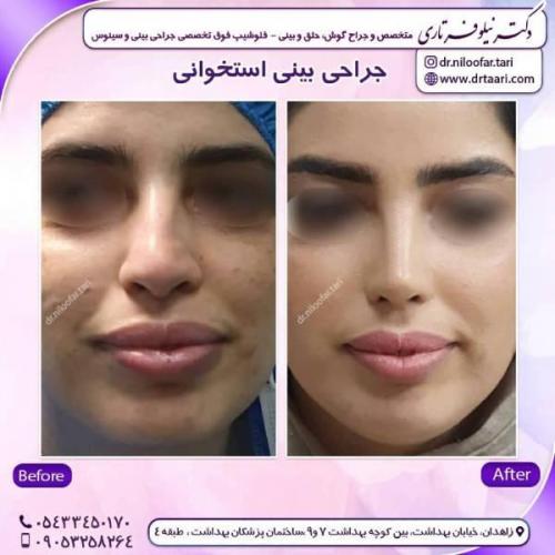 جراحی-بینی-زاهدان-99