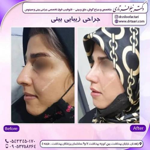 جراحی-بینی-زاهدان102