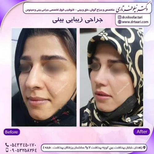 جراحی-بینی-زاهدان103