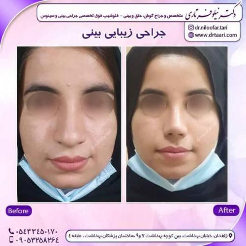 جراحی-بینی-زاهدان121