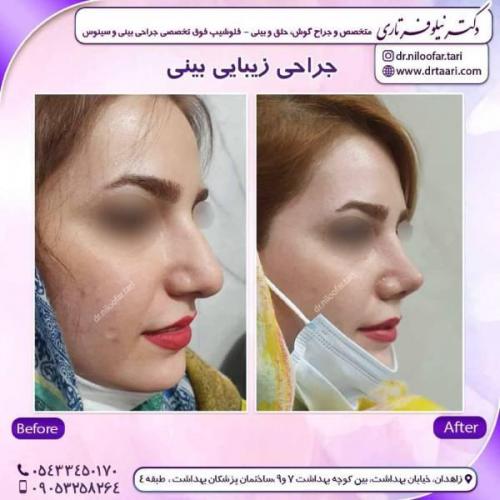 جراحی-بینی-زاهدان123