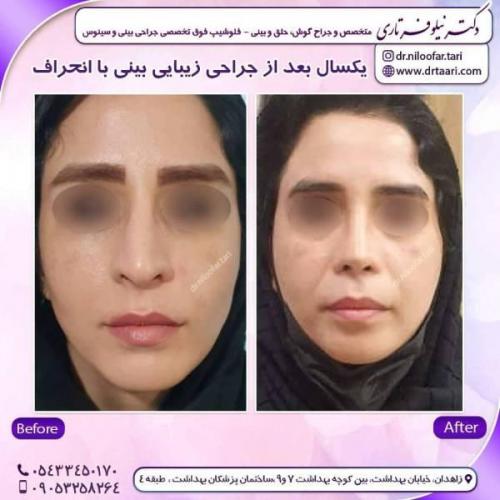 جراحی-بینی-زاهدان136