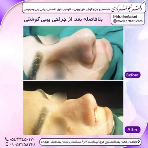 جراحی-بینی-زاهدان138
