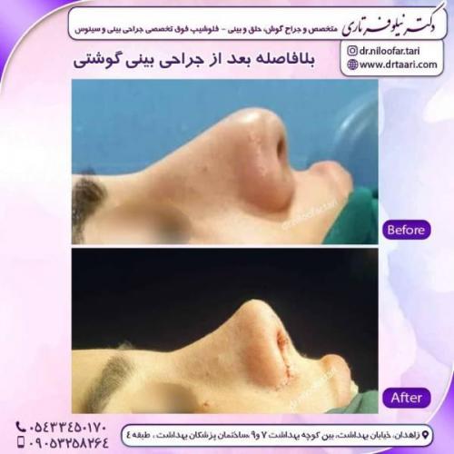 جراحی-بینی-زاهدان139